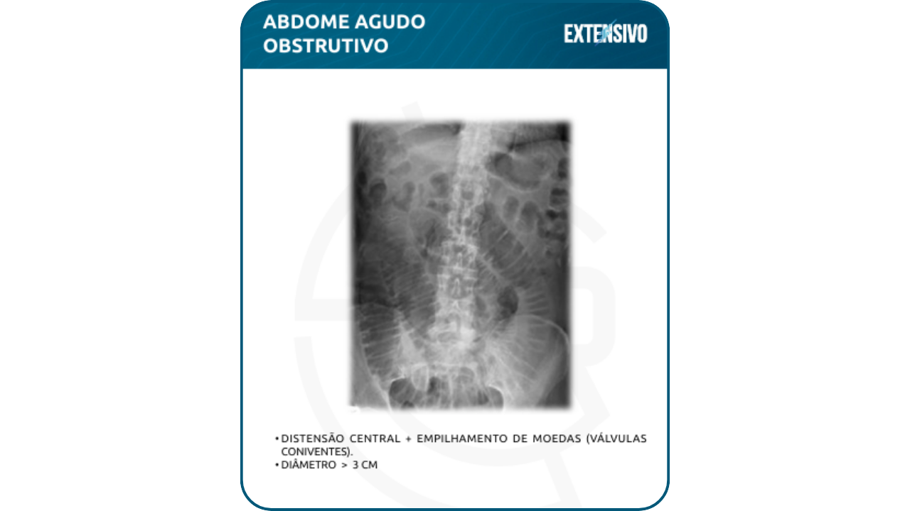 radiografia abdome agudo - empilhamento de moedas